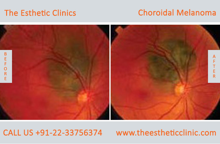 Choroidal Melanoma Eye Cancer Treatment before after photos in mumbai india (1)